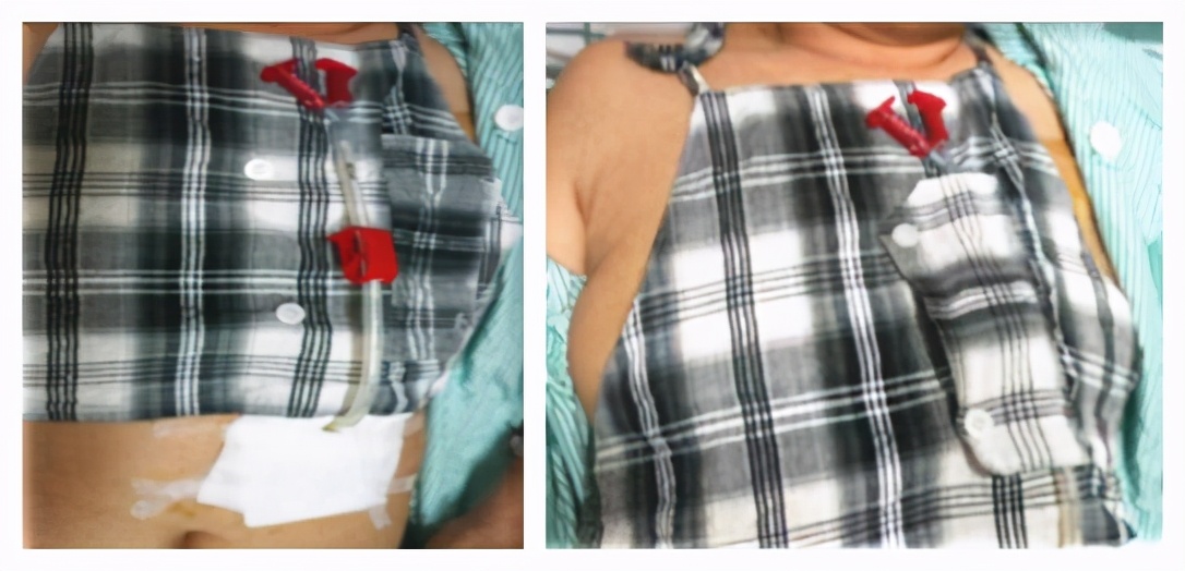 胃造瘘可以用嘴吃饭吗,胃造瘘如何进食是正确的