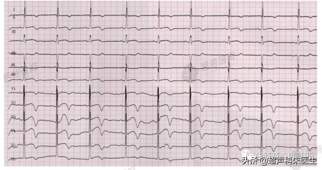 t波倒置诊断,t波倒置如何区分严重程度