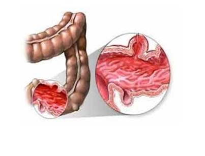 日本首相溃疡性结肠炎,日本首相得溃疡性结肠炎
