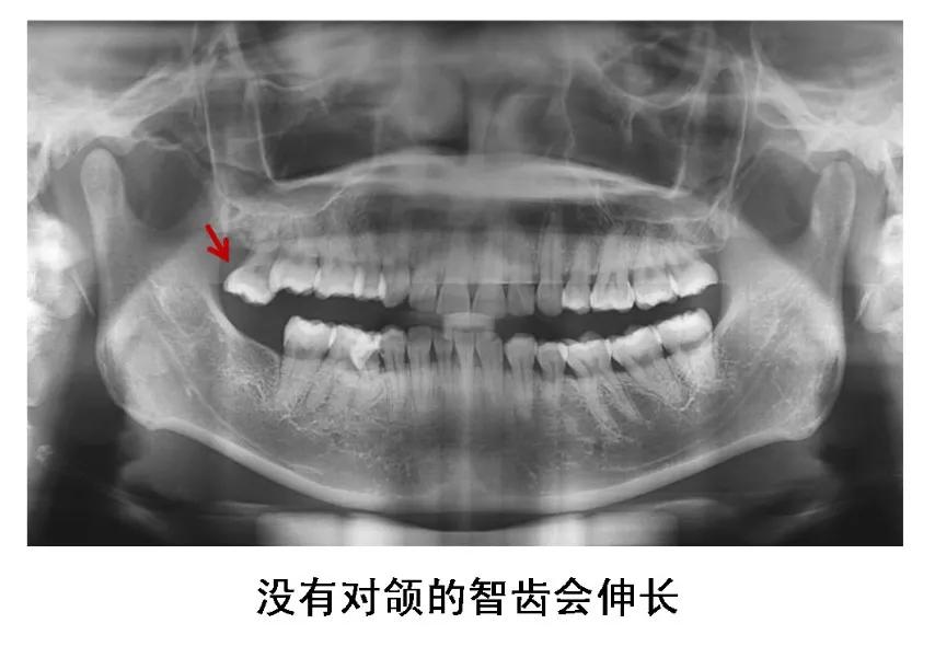 明星拔了智齿有垮脸的吗,明星拔完智齿