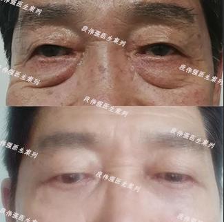 去眼袋手术分为几种,祛眼袋手术哪种最好