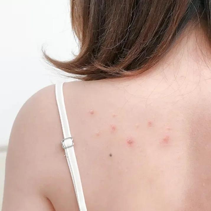 又到了穿小裙的季节，鸡皮女孩该怎么办……