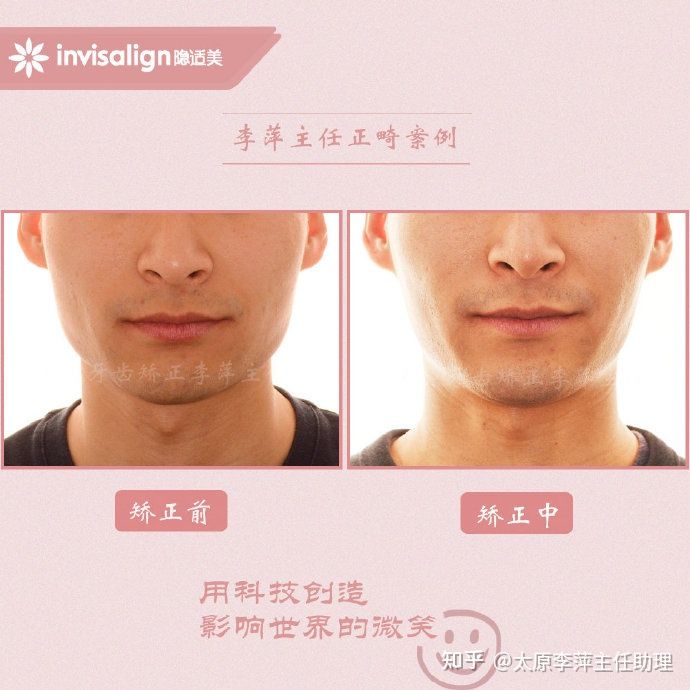 重度拥挤矫正牙齿适合隐形牙套吗,广州成人牙齿矫正推荐隐形牙套