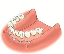 缺失半口牙怎么种植,半口牙缺失不种植还有其它办法吗