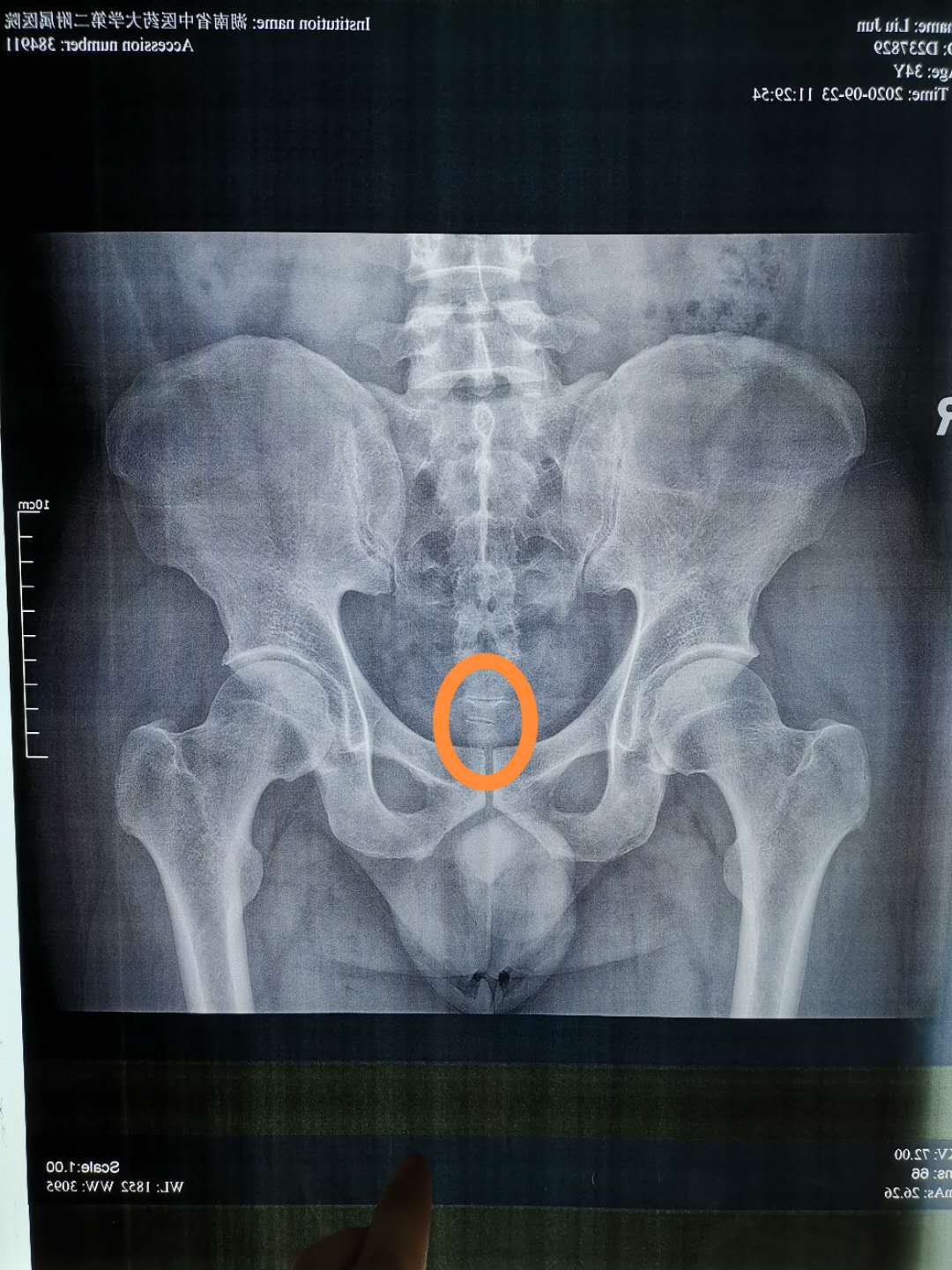 屁股尖疼是怎么办,屁股尖骨头疼痛怎么办