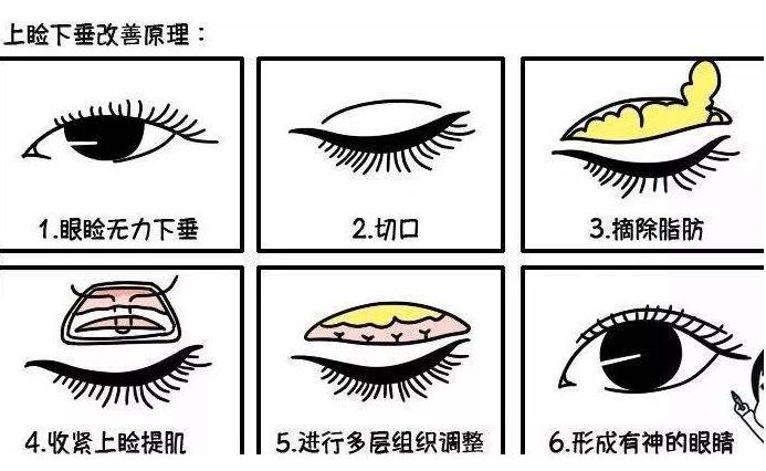 眼皮松弛下垂最好解决方法,眼皮松弛下垂最好解决方法小妙招
