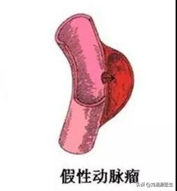 「免疫相关不良妊娠答疑解惑40」——系统性血管炎