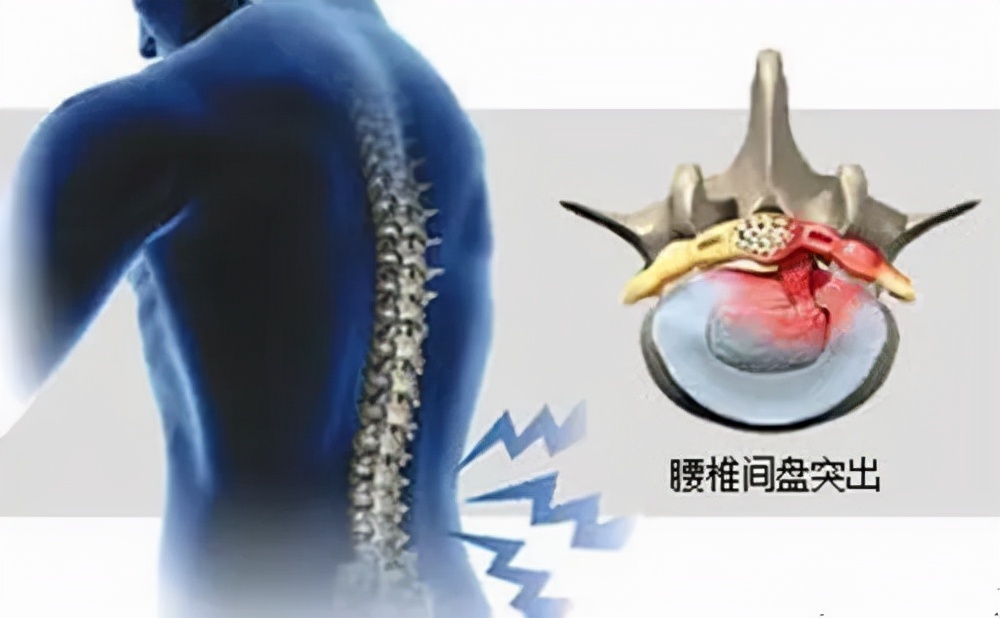 腰腿痛病因病机是什么,腰腿痛的病因全在这里了