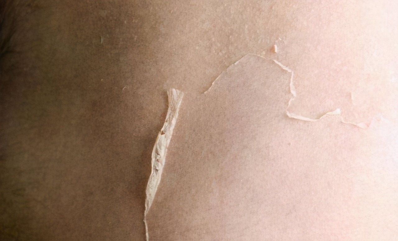 如何清理皮肤上口香糖,衣服粘口香糖怎么处理干净