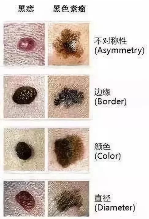 点大些的痣最安全有效的方法,痣可以随便点吗