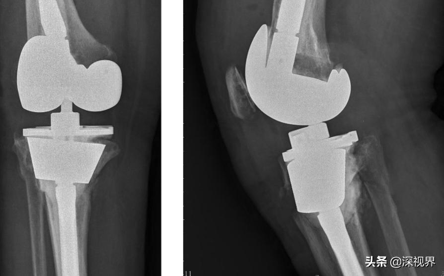 机器人做手术比人工更好吗,机器人做手术越来越靠谱阅读答案