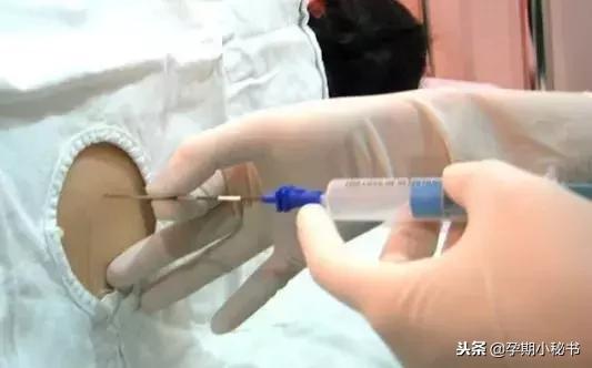 剖腹产最疼的是什么步骤,剖腹产手术步骤详解