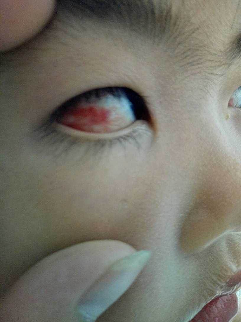 三岁小孩用错眼药水怎么办,三岁孩子误滴了大人用的眼药水