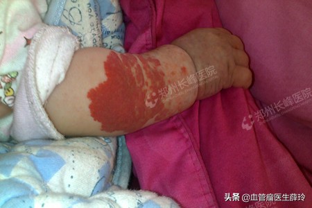 血管瘤胎记长在头部的危害,济南胎记血管瘤医院靠谱吗