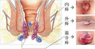 严重的痔疮用传统还是微创,生痔疮用什么药好呢