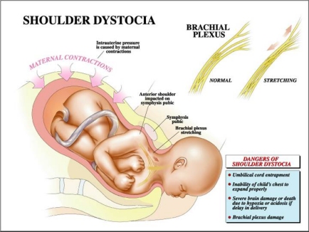 新生儿锁骨骨折是谁的责任,新生儿锁骨骨折是怎么造成的