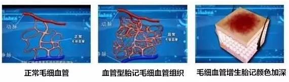 鲜红斑痣越长越大该怎么办?