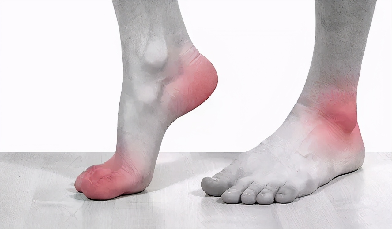 风湿关节痛和痛风是一样的吗,大关节痛是痛风还是类风湿