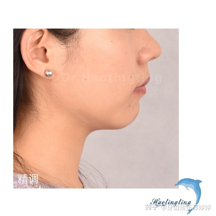 上海成人牙齿矫正失败案例,上海牙齿矫正郝婷婷医生