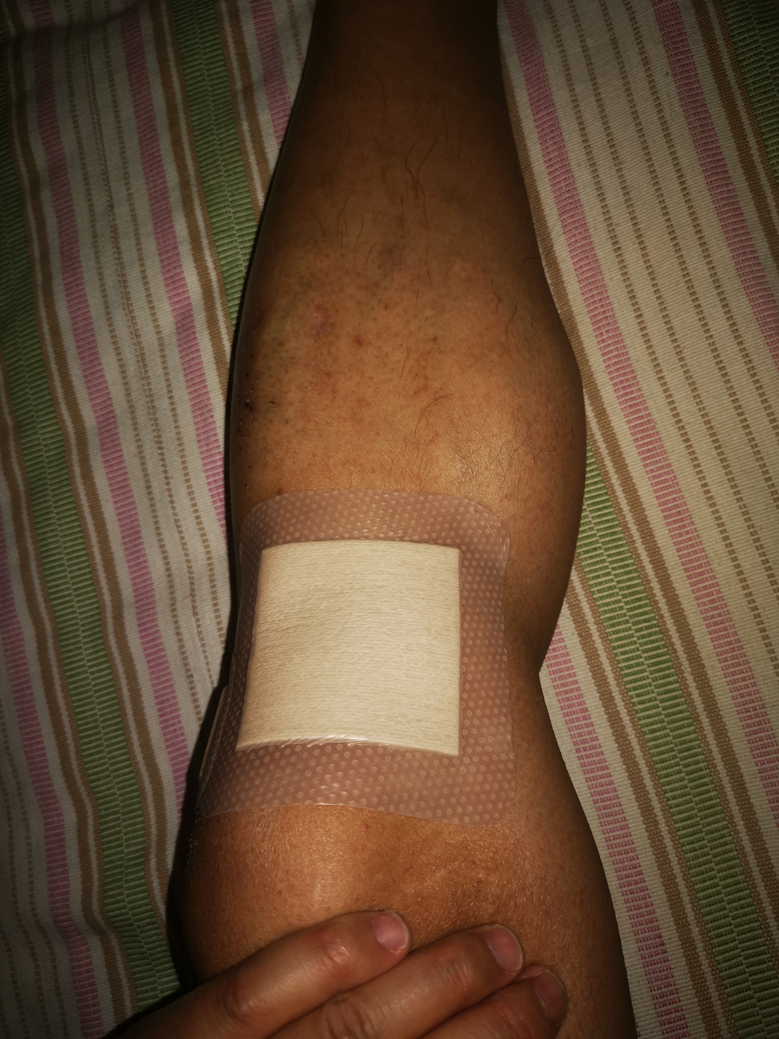 瑞典墨尼克敷料,瑞典墨尼克美皮护疤痕贴有效吗