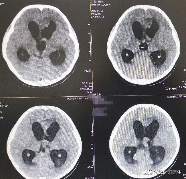 脑出血后脑子里血满了还能治吗,脑出血患者脑子恢复挺好能醒吗