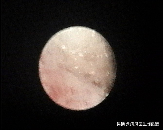 痛风是可以治愈的风湿病，但是请不要迷信“特效药”