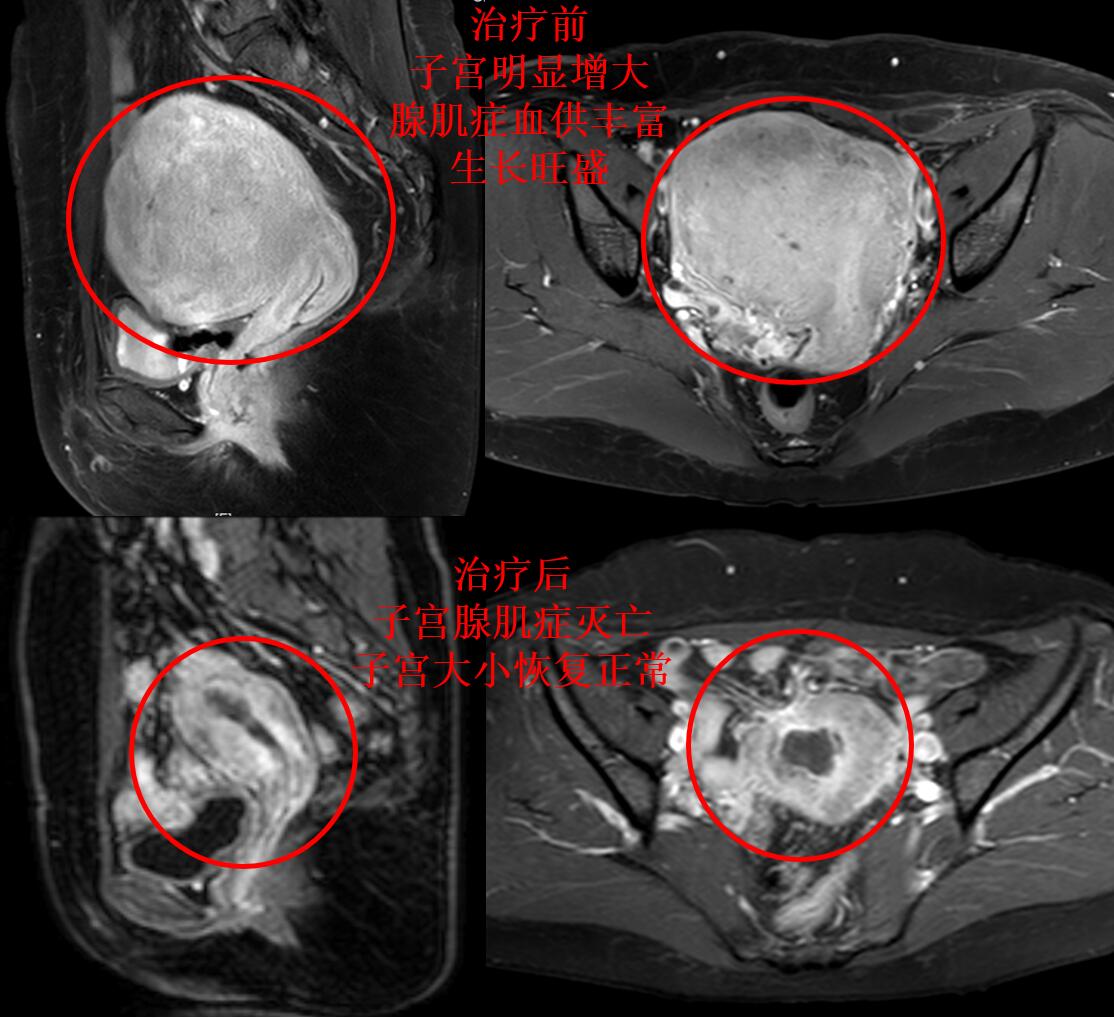 子宫腺肌症痛经中医能治好吗,子宫腺肌症引起的痛经艾灸哪里