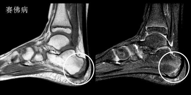 早起下床脚跟痛,早起下床脚踩地脚掌刺痛
