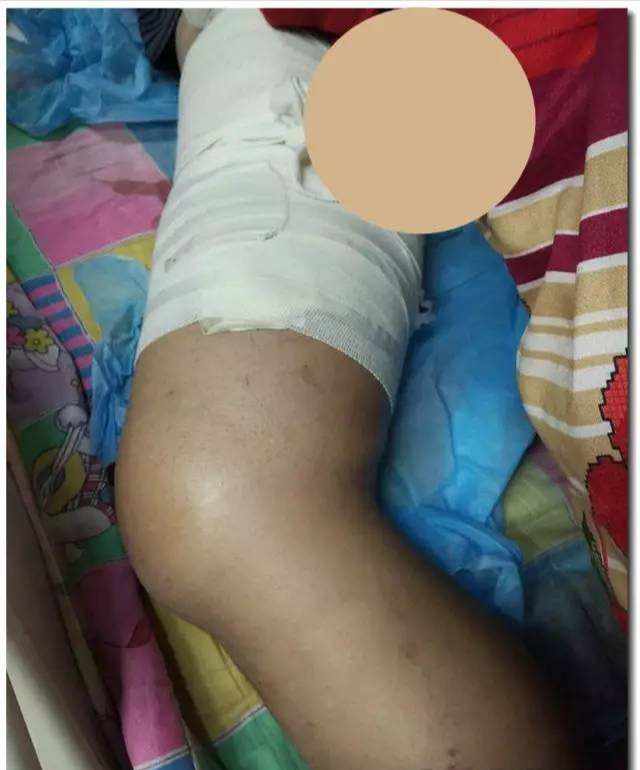 做了心脏造影后手腕刀口有渗血,做了心脏造影后伤口多少天能见水