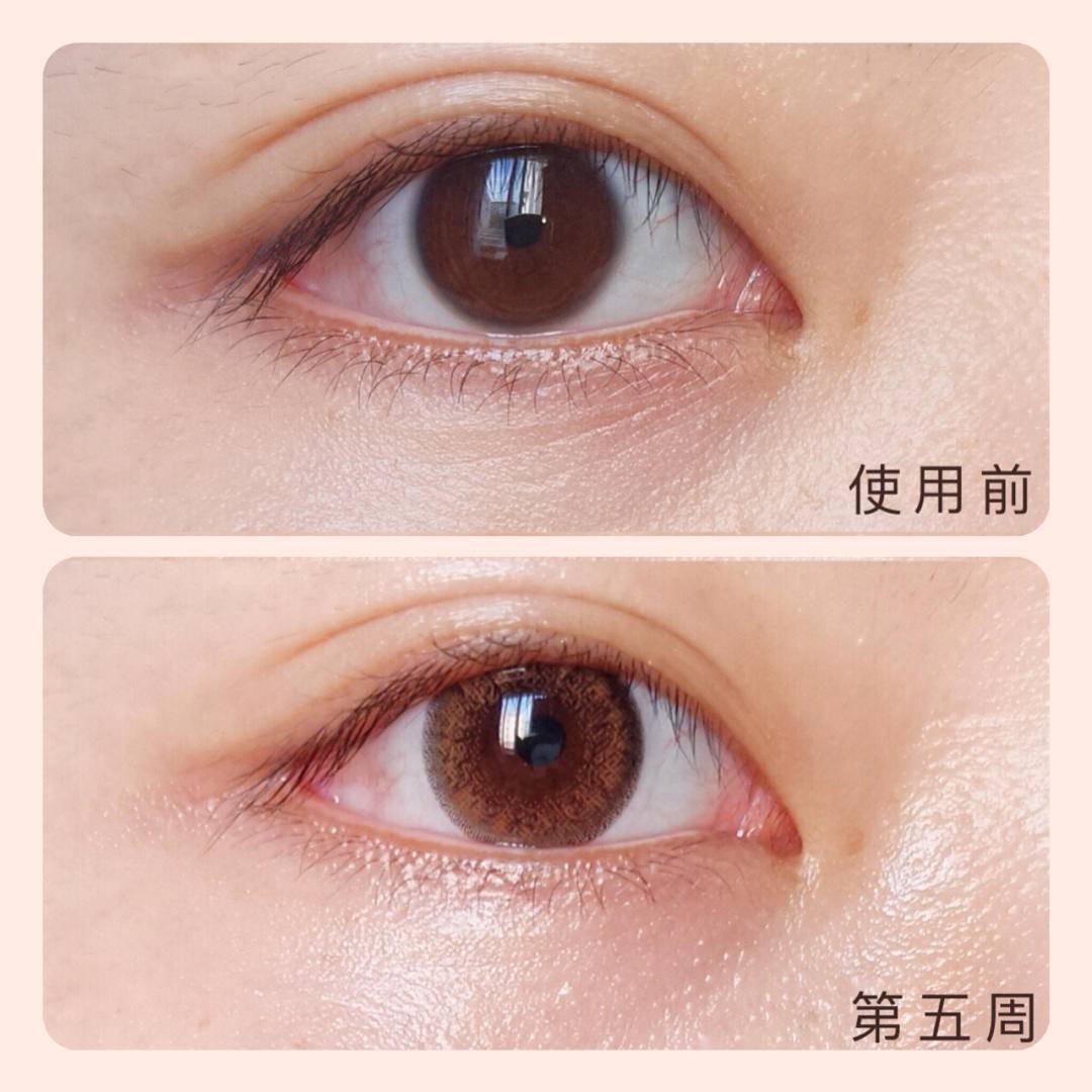 眼睛没有细纹需要眼膜吗,眼膜有用吗能去皱纹吗