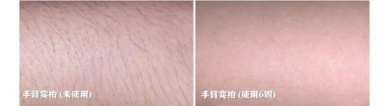 j-style脱毛仪,j-style脱毛仪怎么样