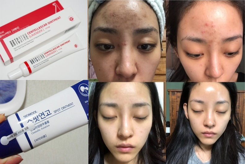 真的很可以买！韩妞最爱用「去疤乳膏TOP3」讨厌的痘印全都掰