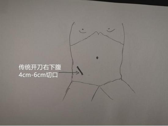 热血外科|Dr.Liu聊科普:阑尾炎究竟是何方妖孽？