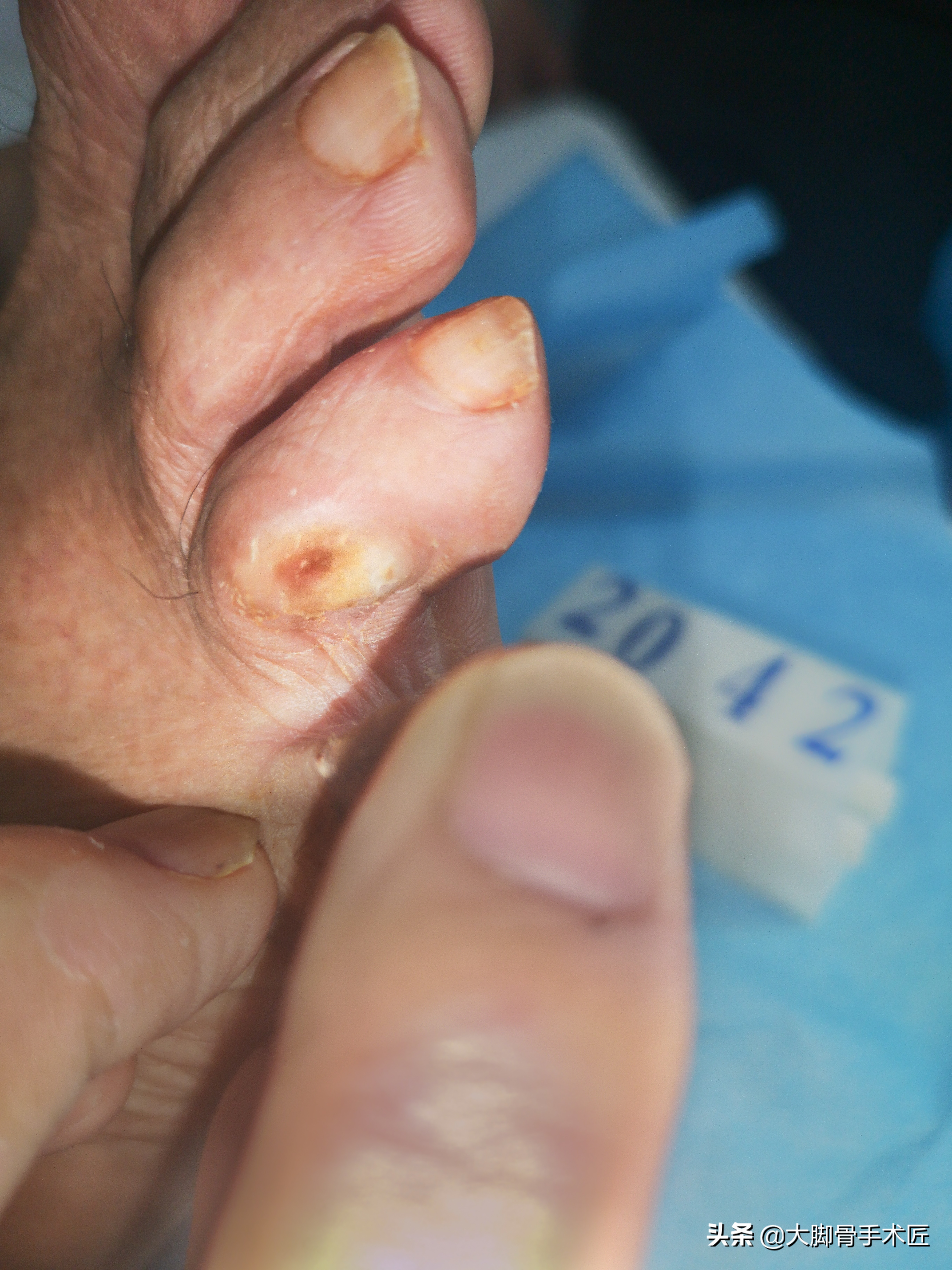 大脚骨导致哪里疼,大脚骨疼痛一招搞定