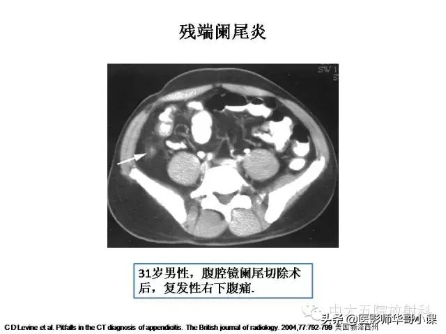 阑尾炎课件,阑尾炎的超声课件