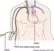 护士picc导管维护,护士picc相关知识薄弱