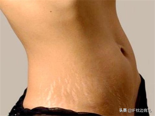 怀孕期间怎么预防妊娠纹,怀孕以后怎么预防妊娠斑