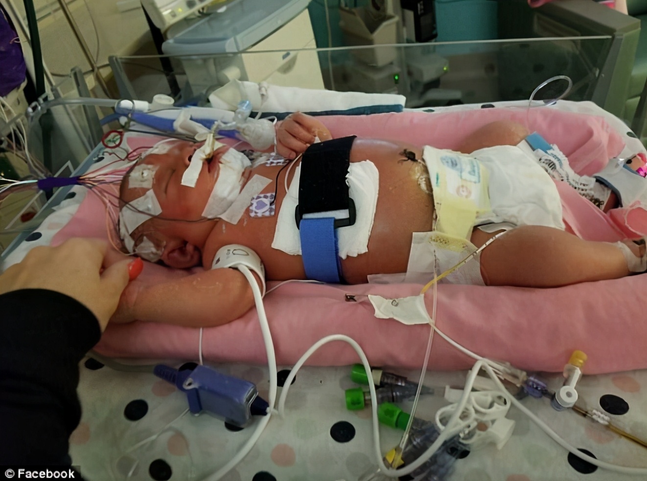 嘴上老是起泡与hpv病毒有关系吗,孕期感染hpv可怕吗