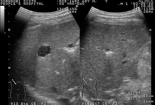 发现肝部有小结节用治疗吗,发现肝脏结节要做哪些检查