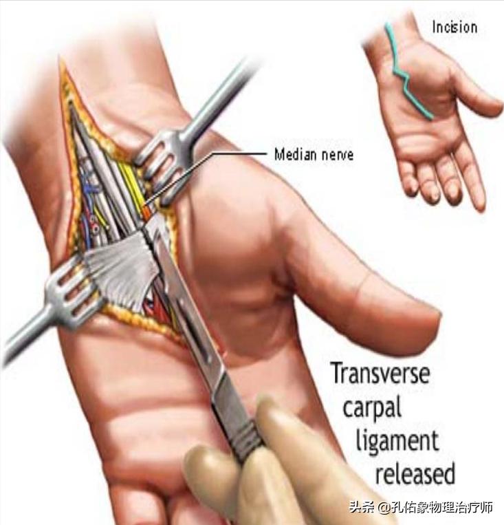 手部麻木长时间不缓解是什么原因,手部麻木无力怎么办