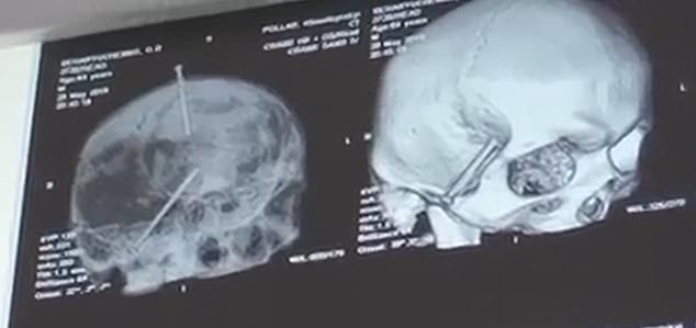 男子与家人激吵欲自杀，竟向头钉入2枚6厘米长钉，结果非同寻常