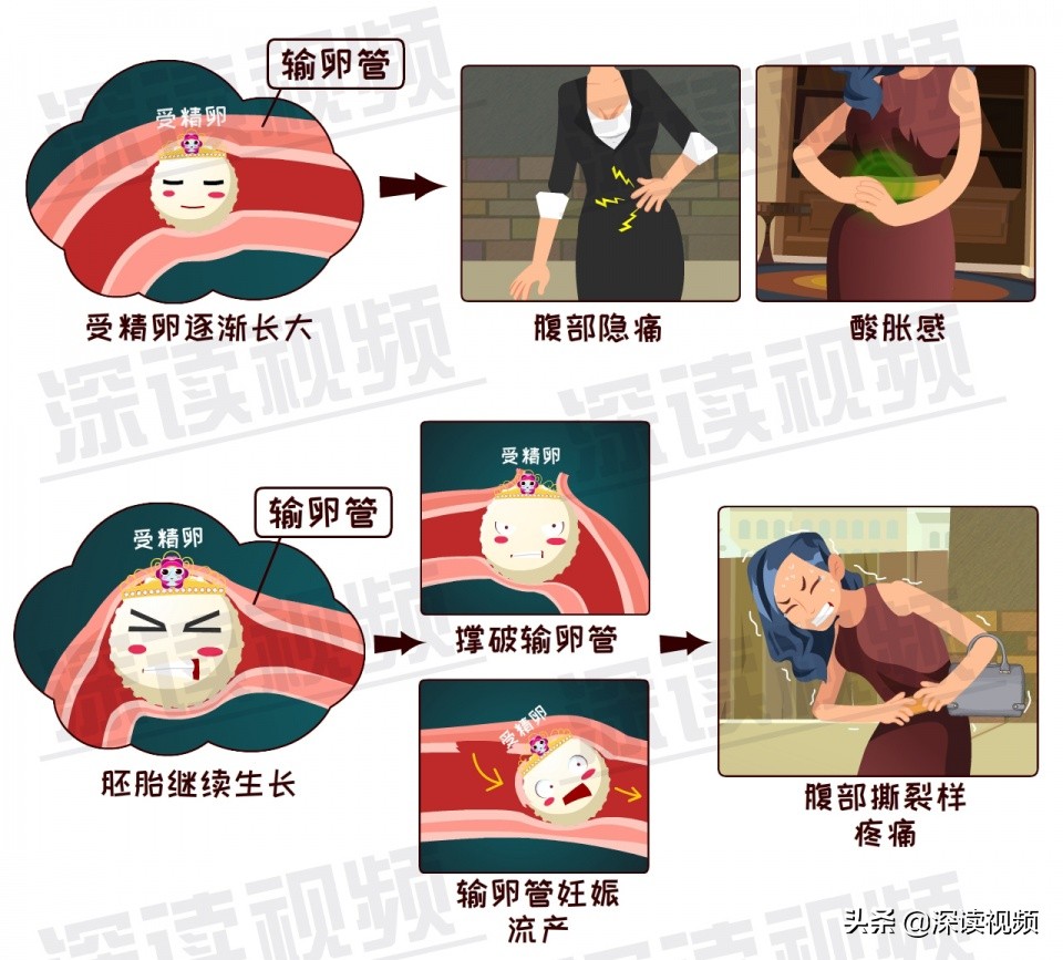 安以轩开刀保命实因宫外孕?受精卵去哪了?竟让孕妈流产大出血?