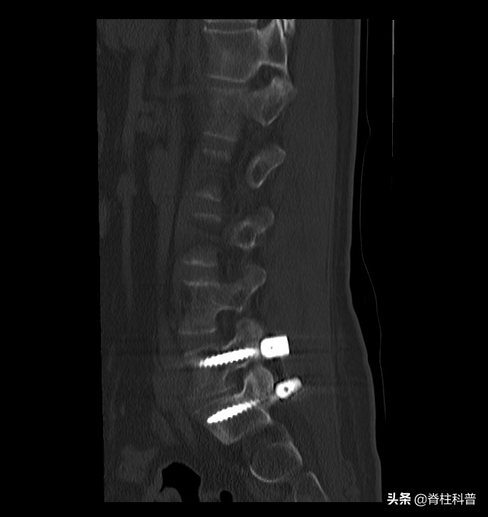 x光看不清楚ct显示骨折,x光看不出腰突吗