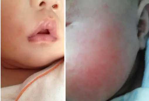 湿疹泛红粗糙干裂，这些宝宝常见的皮肤问题，怎么才能解决？