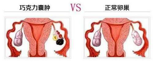 肚子里能长“巧克力”？没有骗人，是真的！