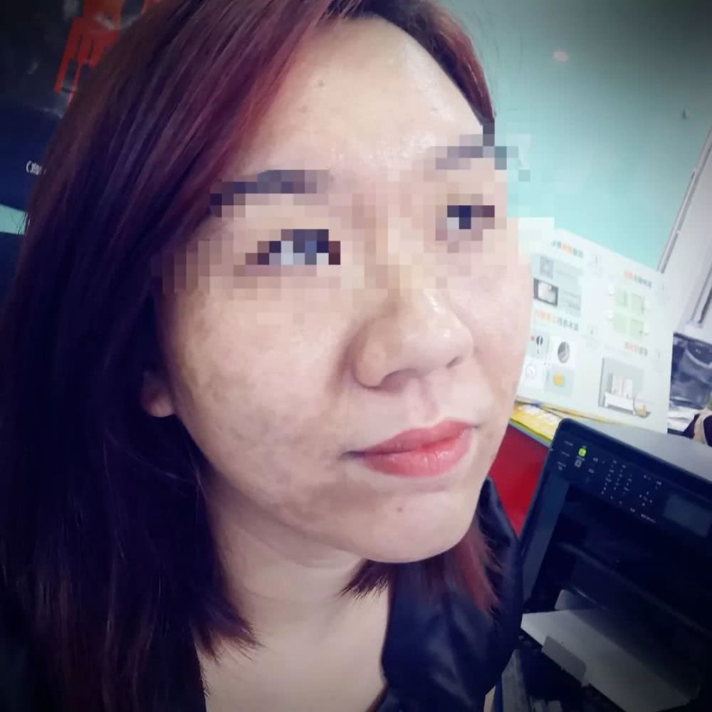 南宁一大学老师打“水光针”,脸部出现大量黑斑