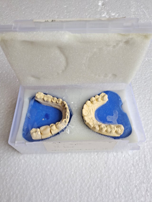 自己补牙的真实经历,第一次补牙成功案例