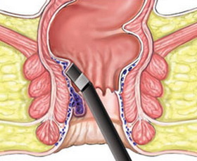 都说十人九痔痔疮能根治吗,十人九痔八不治