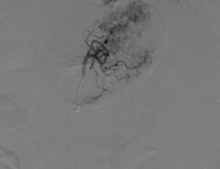 生命不能承受之重完整版视频,胃左动脉栓塞减肥手术后遗症