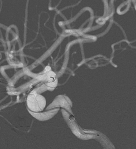 Tubridge®治疗多发性动脉瘤